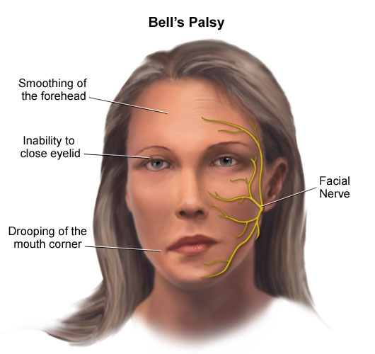 Bell´s Palsy
