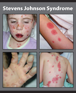 Stevens-Johnson syndrome